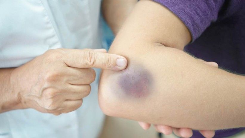 Intenzivne vježbe mogu da stvore modrice u području mišića koji su u upali