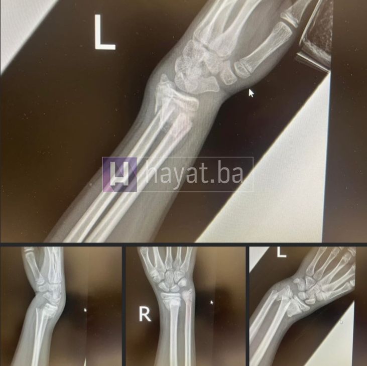 Izvođenje izazova može dovesti do opasnih i fatalnih povreda, tako se posljednjih dana u bolnicama povećava broj djece sa povredama ruku