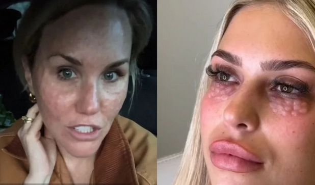 Stručnjaci upozoravaju one koji žele posvijetliti područje ispod očiju nekirurškim zahvatom da budu svjesni da bi na licu mogle nastati opasne 'kvržice', a šteta će kod nekih biti