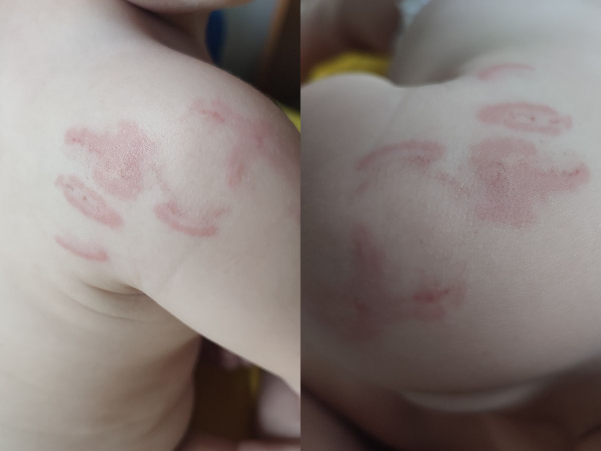 Roditelji u šoku: Beba izgrižena u vrtiću! Evo šta su za Hayat.ba rekli iz ove ustanove
