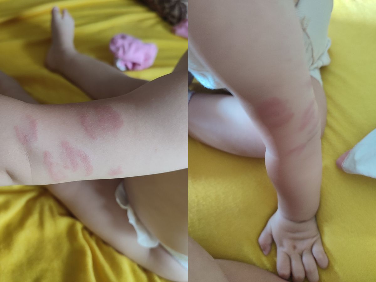 Roditelji u šoku: Beba izgrižena u vrtiću! Evo šta su za Hayat.ba rekli iz ove ustanove