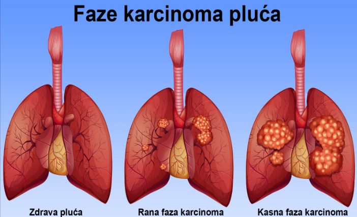 Prema Američkom udruženju za rak (ACS), rak pluća je drugi najčešći rak kod muškaraca, odmah iza raka prostate, i kod žena, odmah iza raka dojke.