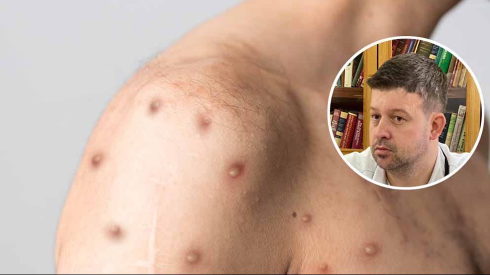 Izaziva simptome nalik gripi, koji uključuju groznicu, glavobolju, bolove u mišićima
