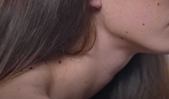 Mladež je grupa ćelija kože (poznata i kao melanociti) koja se može pojaviti bilo gde na vašoj koži, kaže dermatolog dr Pol Kertis