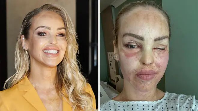 Zbog toga je prošla kroz čak 400 operacija i nakon dugo vremena uspješno se oporavila