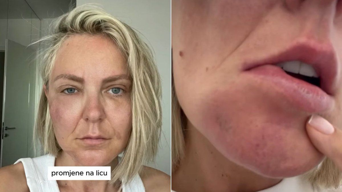 Na Instagramu je otkrila detalje, odnosno kako ta agonija traje više od godinu dana