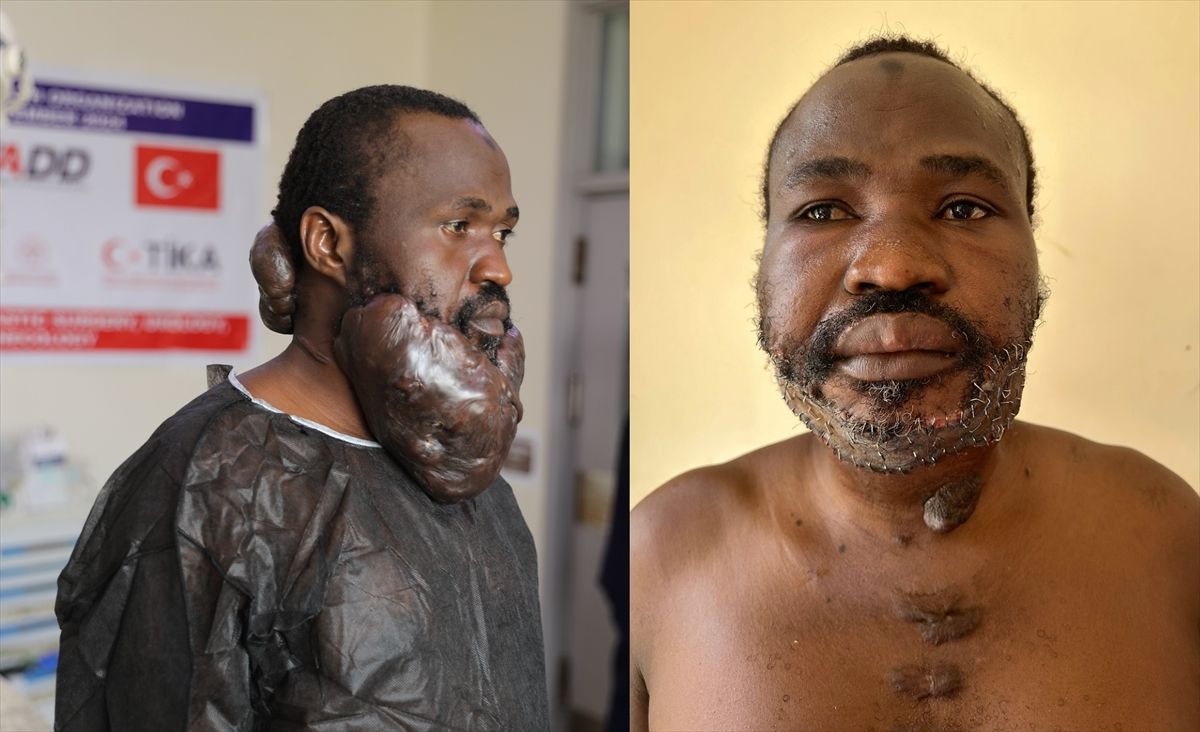 Pacijent je oko sedam, osam godina hodao okolo s masom teškom skoro pet kilograma