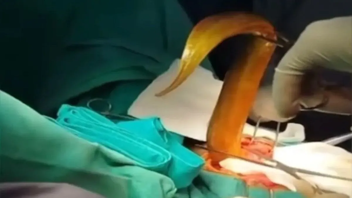 Šok na operacionom stolu: Ljekari mu u tijelu pronašli živo biće koje ga izgriza