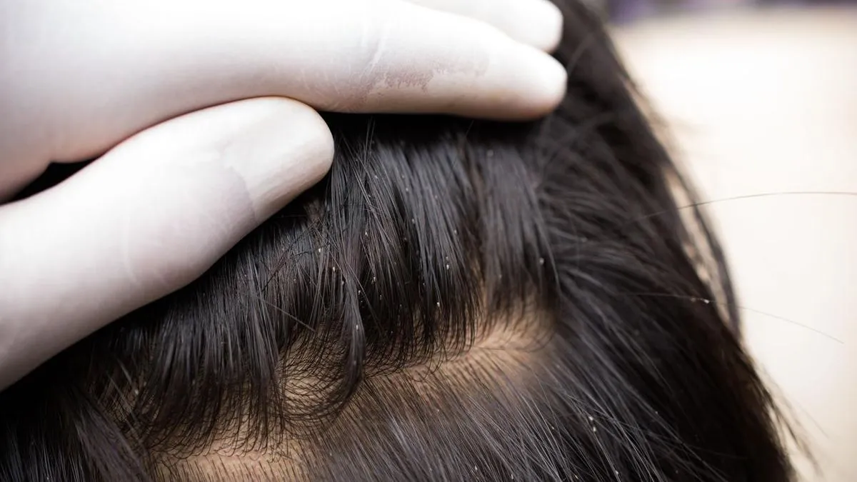 Skoro svake godine u pojedinim osnovnim školama pojave se vaške, odnosno uši. 