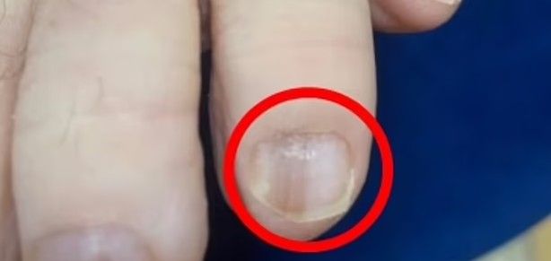 Tačnije, David je razvio subungualni melanom — rijedak i agresivan oblik raka kože koji se razvija ispod nokta