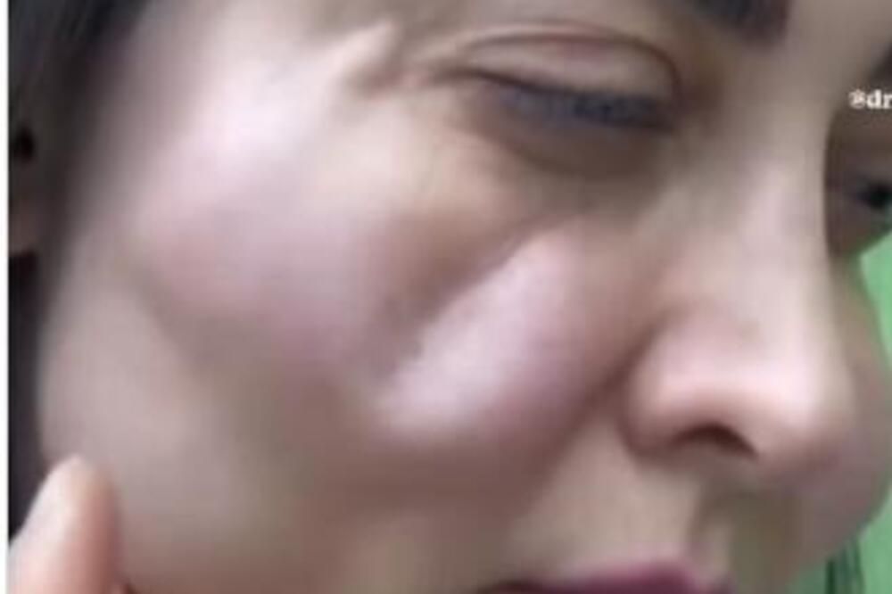 S obzirom da na samom snimku, a i mnogi u komentarima tvrde da je u pitanju filer ili botoks, oglasio se i dr Dragan Stojićević i otkrio šta je zapravo u pitanju