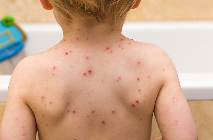 ZDK traži kraj epidemije: Tri sedmice bez ijednog slučaja morbila