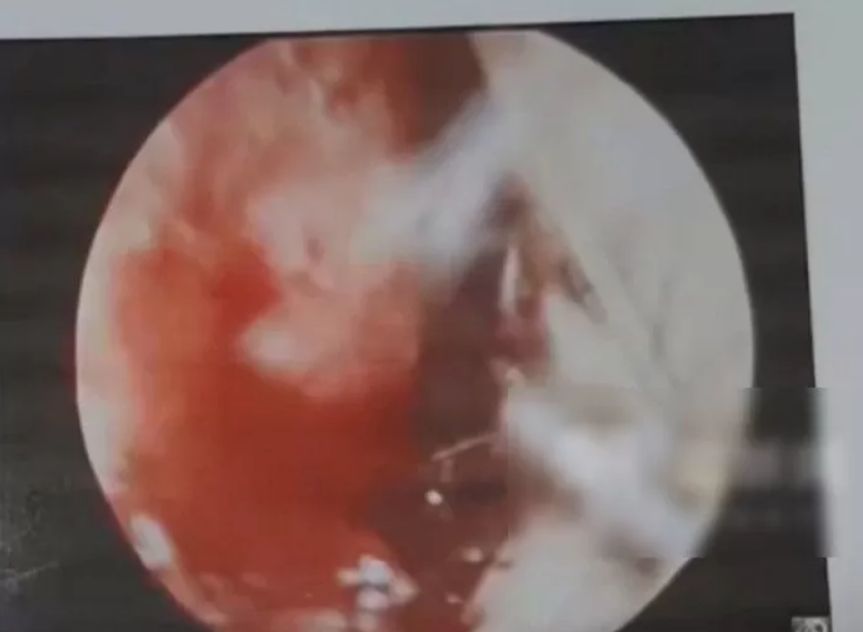 Muškarac zbog 'čačkanja nosa' završio na hitnoj operaciji, pukla arterija