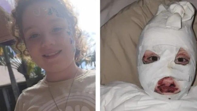 Djevojčica (8) obukla duksericu s Temua i jedva preživjela: Topila se poput plastike