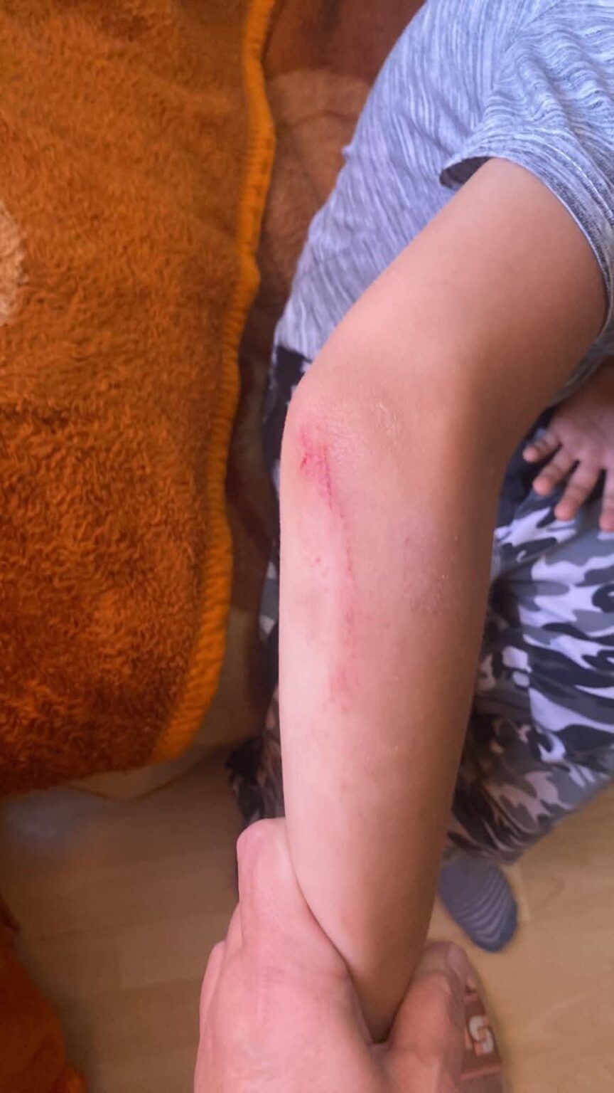 Dijete je bilo svjesno, komunikativno, ali sa vidljivim povredama, uključujući i ekskorizacije (ogrebotine) na licu i podlivima