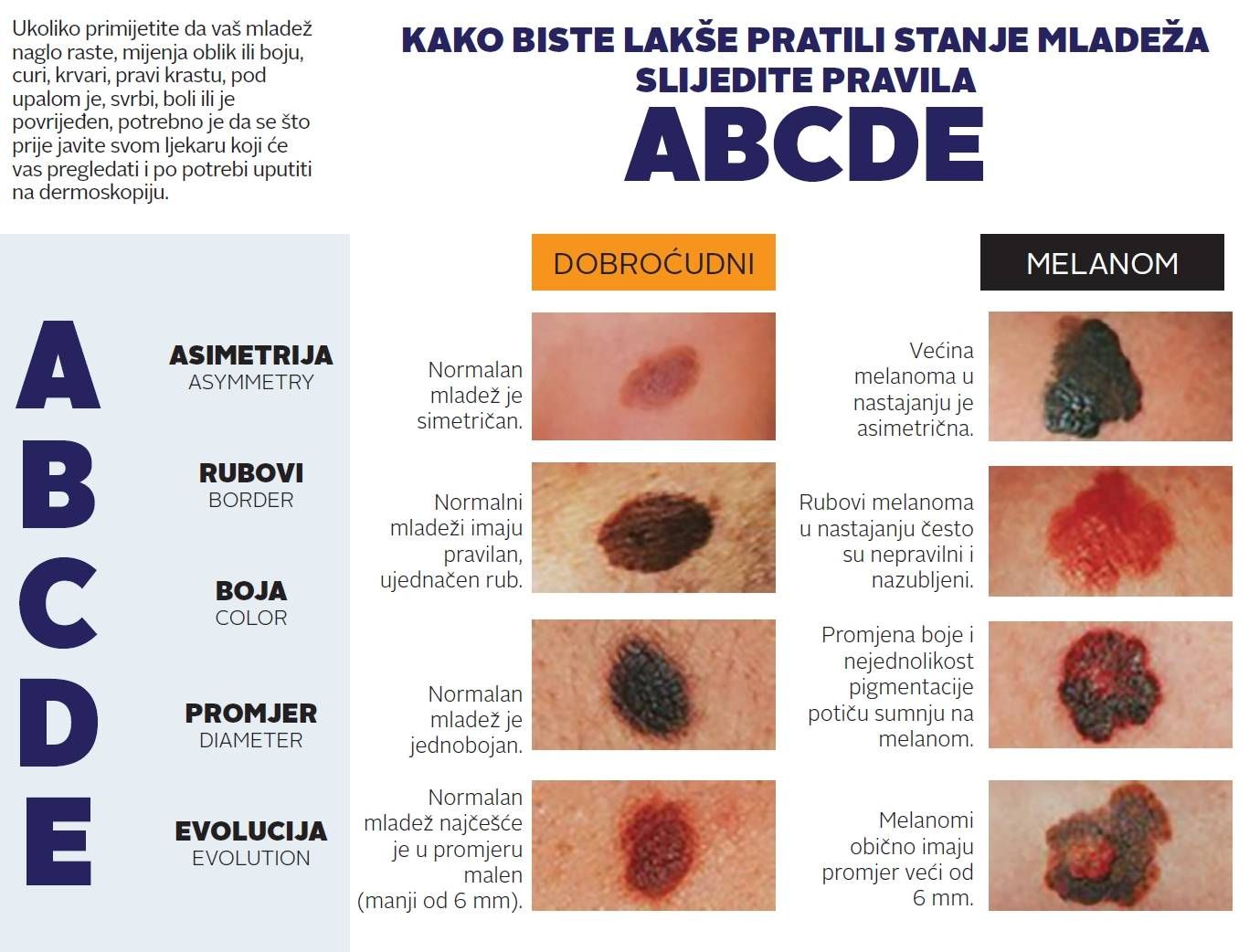 Rano prepoznavanje melanoma ključno je za preživljavanje. Melanom se često javlja kao promjena na koži koja mijenja izgled, a može nastati i iz mladeža.