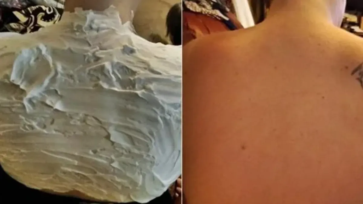 Ukoliko izgorite na suncu, ovaj trik će vas spasiti za pola sata