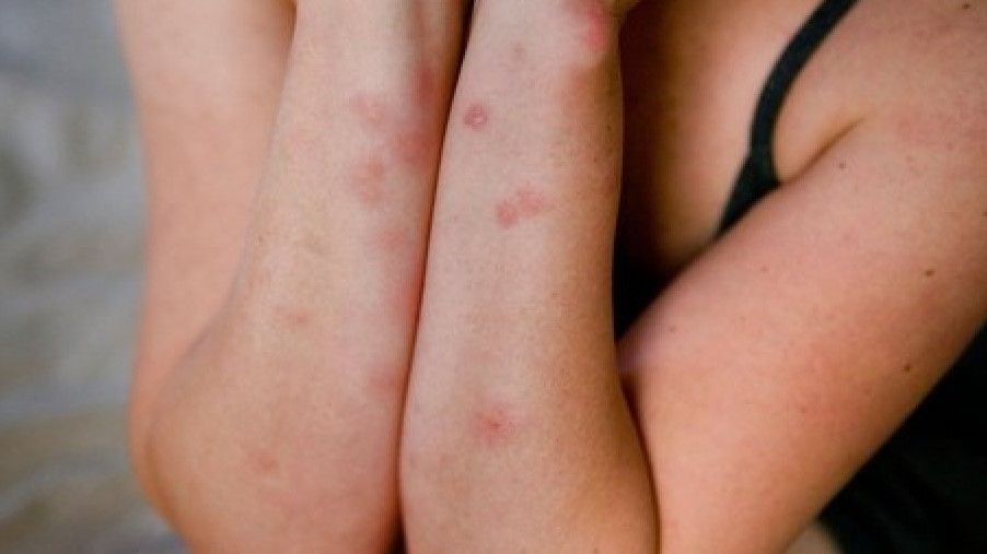 Stjenice u stanovima: Kako prepoznati njihov ugriz i suzbiti njihovo širenje 