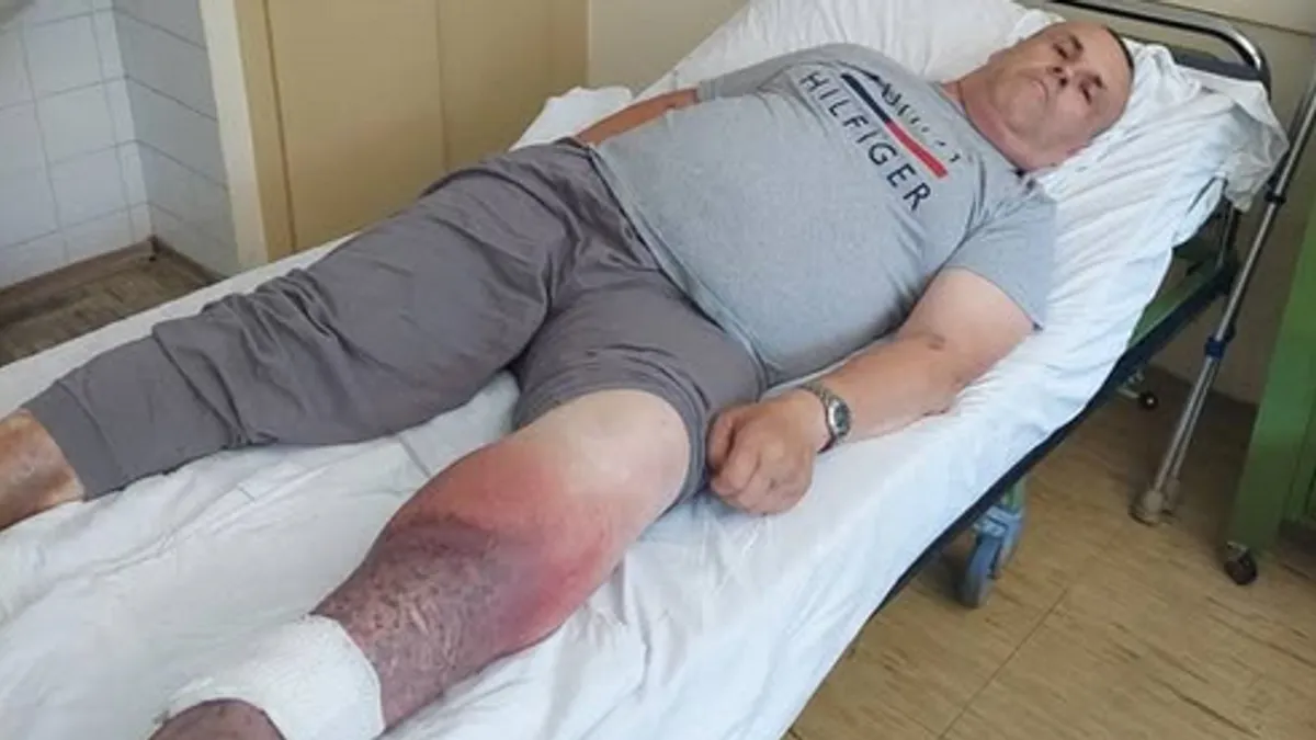 Hasanu Smajiću je uspostavljena i dijagnoza - ciroza jetre hepatitisa b