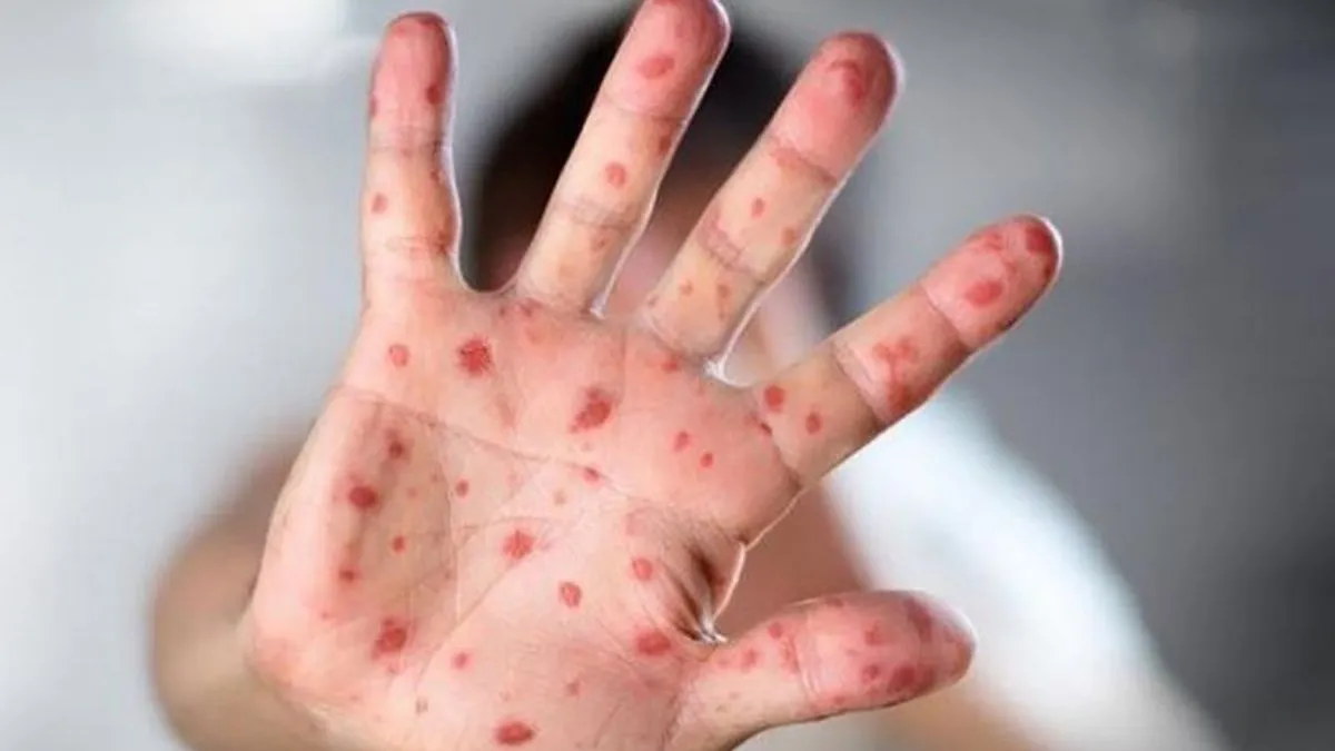 Građani pozvani da nastave s vakcinacijom radi sprječavanja novih epidemija