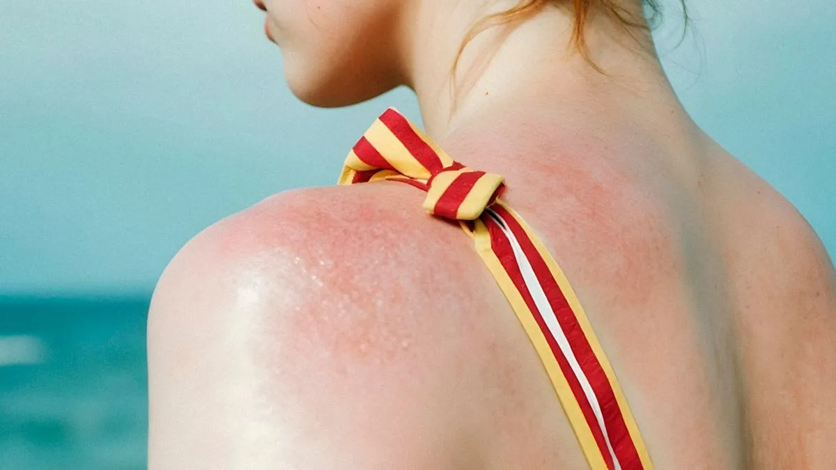 U prevenciji solarne urtikarije odjeća igra važnu ulogu u zaštiti kože.