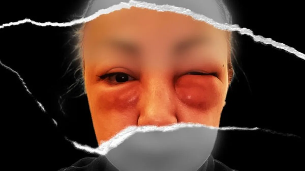 Mračna strana tretmana za ljepotu: Azri deformisano lice u nelicenciranoj ordinaciji