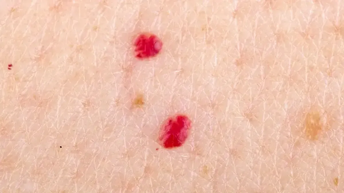 Uglavnom se radi o vrlo malim tačkicama koje se najčešće nalaze na trupu, rukama i ramenima, a žene ih znaju imati na grudima