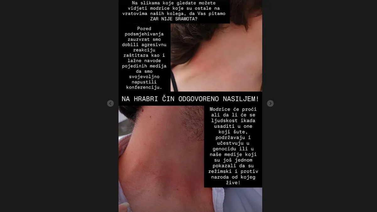 Modrice će proći, ali da li će se ljudskost ikada usaditi u one koji šute, podržavaju i učestvuju u genocidu...