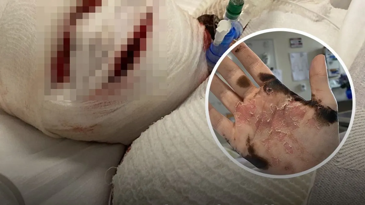 Ženi otpala koža nakon reakcije na lijek koji mnogi koriste: Ima 5 posto šansi za preživljavanje