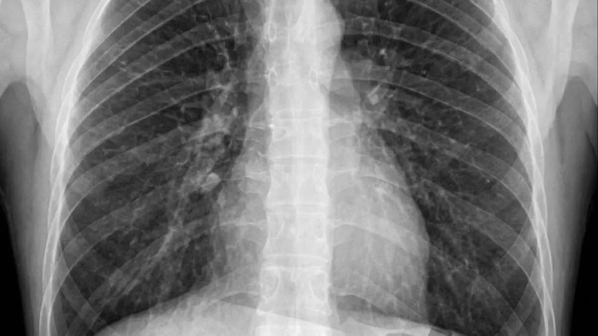 Nakon vađenja umnjaka počeo čudno štucati: Uzrok šokirao i ljekare